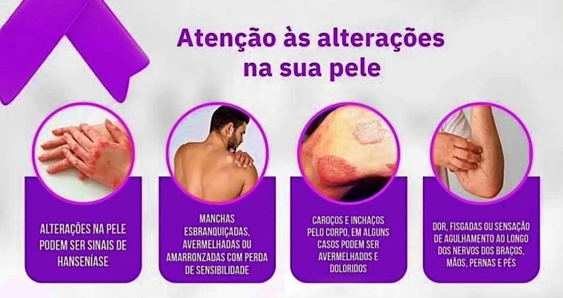 Secretaria de Saúde de Castilho realiza campanha de conscientização sobre a Hanseníase 